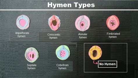 broken hymen|What Is the Hymen: Anatomy, Functions, Types and。